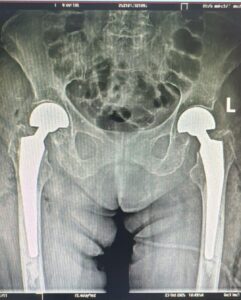 intervenție medicală în premieră la Sibiu